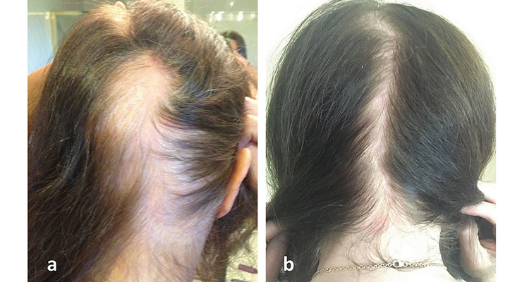 Replenology Hair System Prevents Female Hair Loss | HAPPI