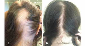 Replenology Hair System Prevents Female Hair Loss