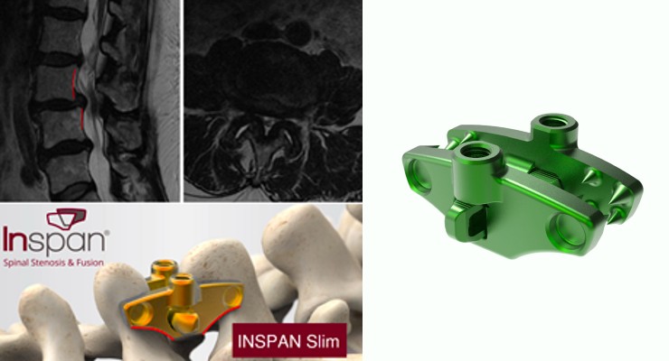 Inspan’s Interspinous Plate Fixation Device Receives FDA Clearance