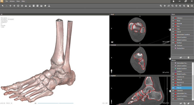 Fine Print: Examining 3D Printing for Orthopedics