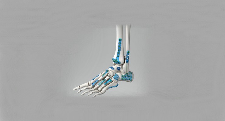 Medline UNITE Launches Calcaneal Fracture Plating System