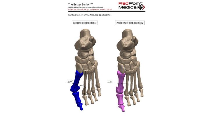 Red Point Medical 3D’s Bunion Surgery System Cleared by FDA