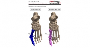 Red Point Medical 3D’s Bunion Surgery System Cleared by FDA