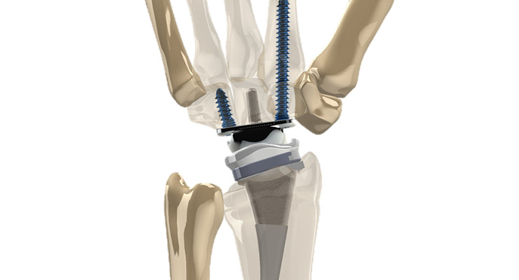 Six Orthopedic Firms En Route to Significant Market Disruption