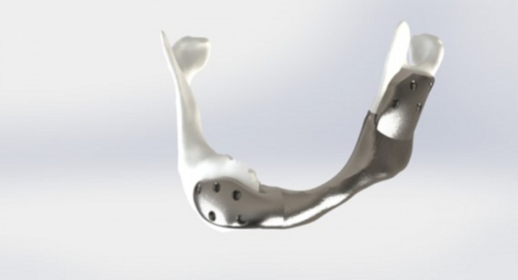 Custom 3D-Printed Titanium Lower Jaw Used in First Successful Surgery
