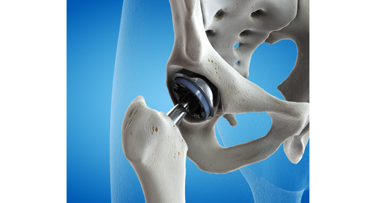 Robust Growth Forecast for Joint Reconstruction Market