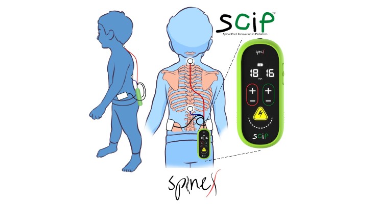 SpineX Demonstrates New Neurostim Device to Treat Cerebral Palsy