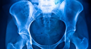  High Vitamin K Intake Linked to Reduced Bone Fracture Risk 