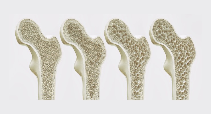 Data Show New AI Approach Enhances Osteoporosis Diagnosis, Monitoring 