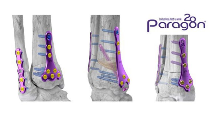 Paragon 28 Releases Supramalleolar Osteotomy System