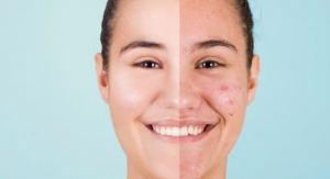 Antioxidant Supplement Enhances Acne Therapy: Study 