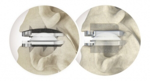 Centinel Spine prodisc System Surpasses 2,500-Implant Milestone